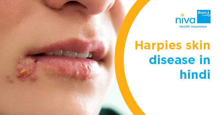 Harpies Skin Disease Reason in Hindi