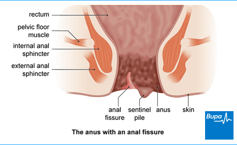 Anal Fissures