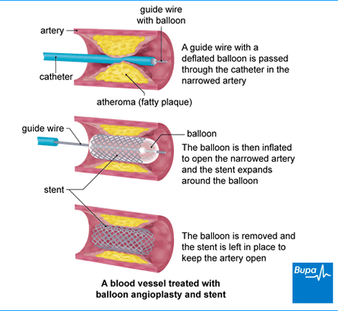 Angioplasty of the leg arteries