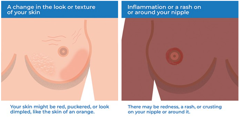 Breast cancer