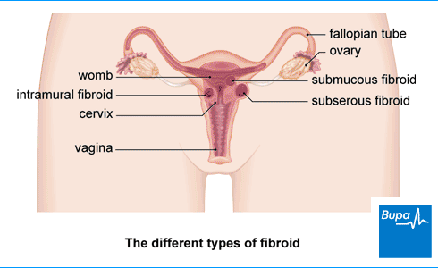 Fibroids_1