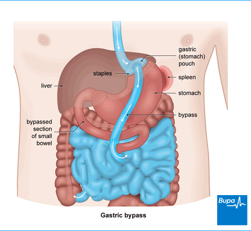 Gastric-bypass