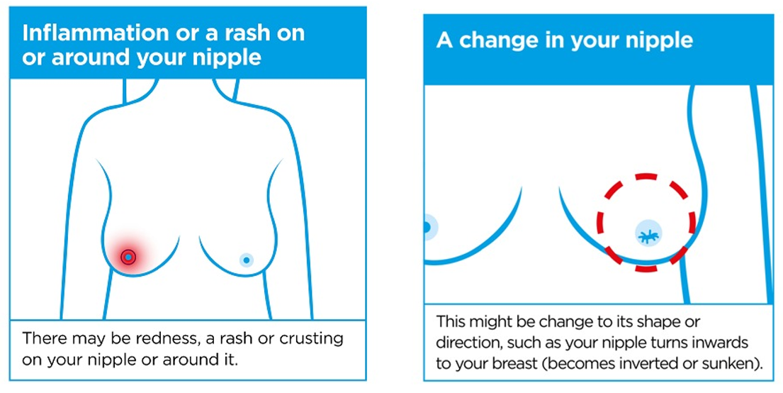 breast_cancer_symptom3