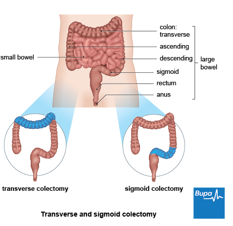 transverse and sigmoid colectomy