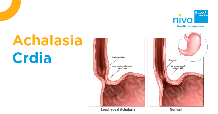 Achalasia Cardia