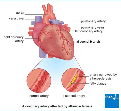 Coronary Artery Disease in Tamil