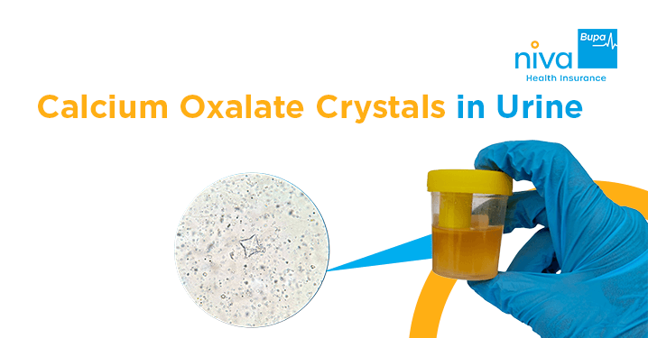 Calcium Oxalate Crystals in Urine