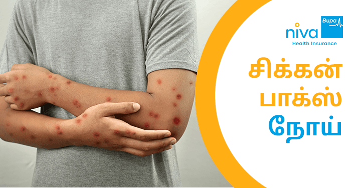 Chicken Pox Treatment in Tamil: குயாகா நோயின் அறிகுறிகள், காரணங்கள் மற்றும் சிகிச்சை முறைகள்