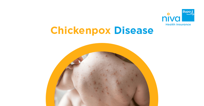 Chickenpox Disease