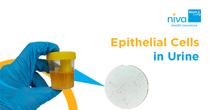 Epithelial Cells in Urine