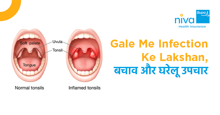 गले में इन्फेक्शन