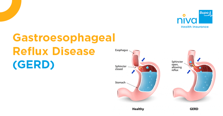 Gastroesophageal Reflux Disease (GERD)