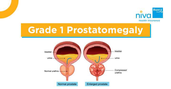Grade 1 Prostatomegaly