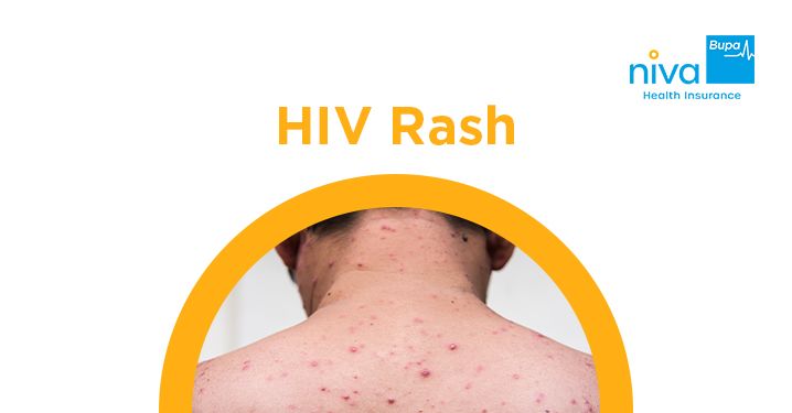 HIV Rash