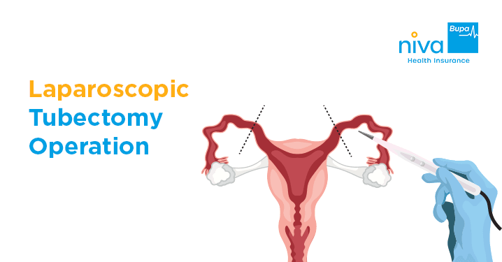 Laparoscopic Tubectomy Operation