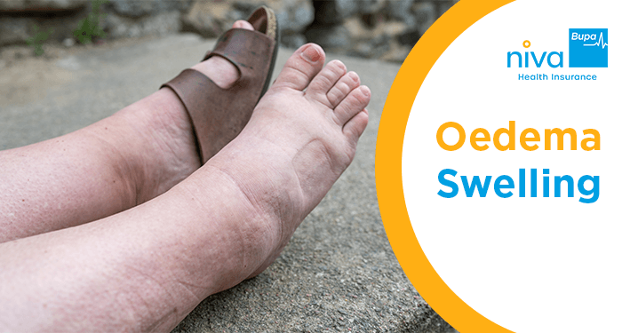Pitting Oedema