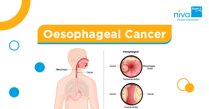 Oesophageal Cancer