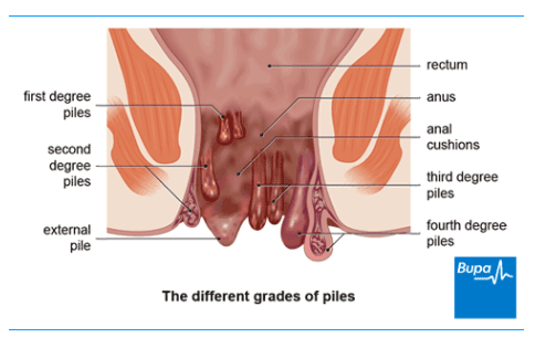 Piles Symptoms in Kannada