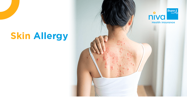 Skin Allergy