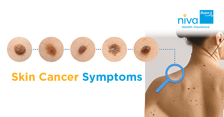 Skin Cancer Symptoms