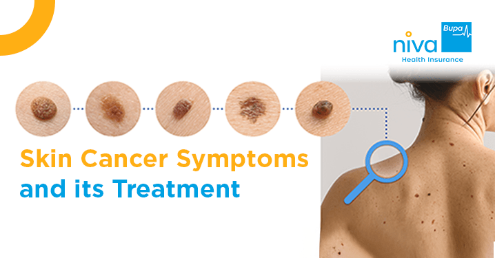 Skin Cancer Ke Lakshan (Symptoms) in Hindi