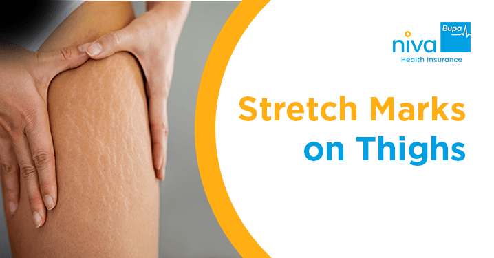 Stretch Marks on Thighs