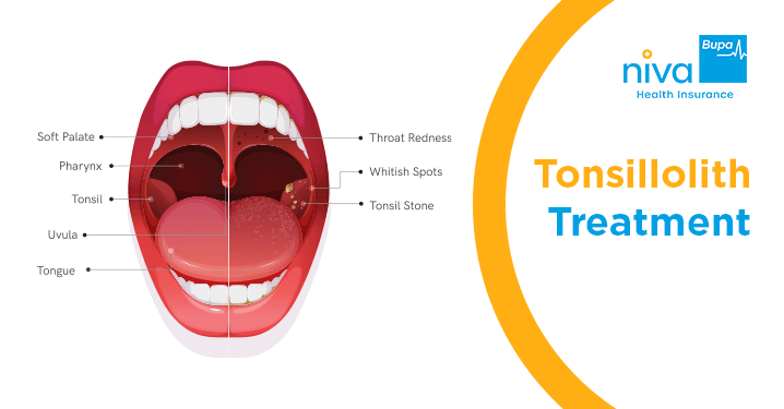Tonsillolith Treatment
