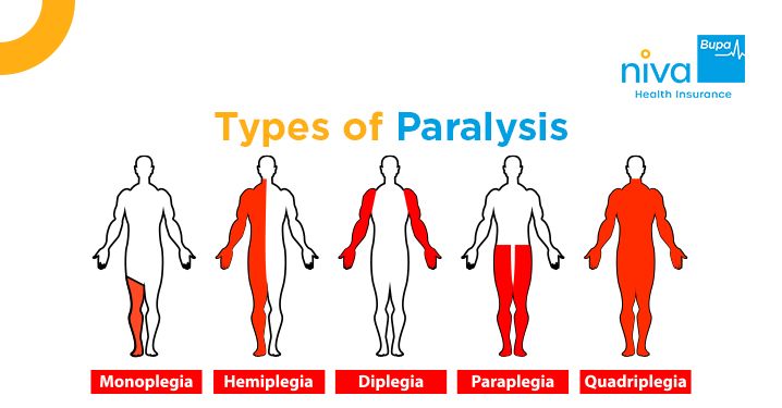 Types of Paralysis
