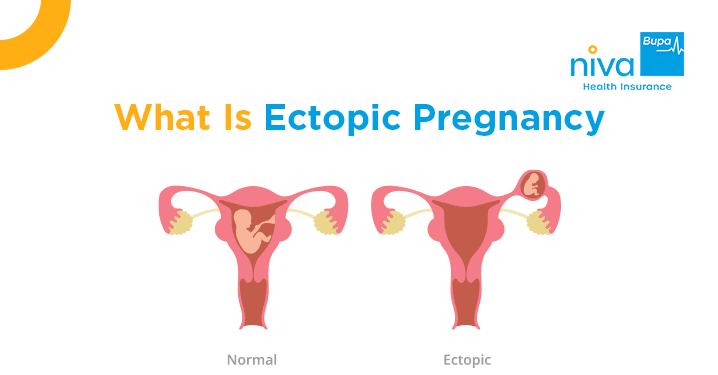 Ectopic Pregnancy in Hindi
