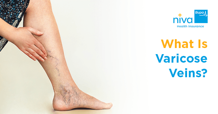 varicose vein treatment in hindi