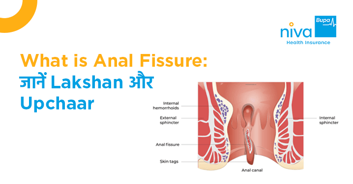 anal fissure in hindi