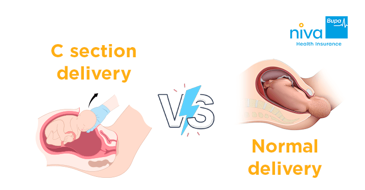 C-Section vs Normal Delivery