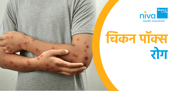 Chicken Pox Disease in Hindi