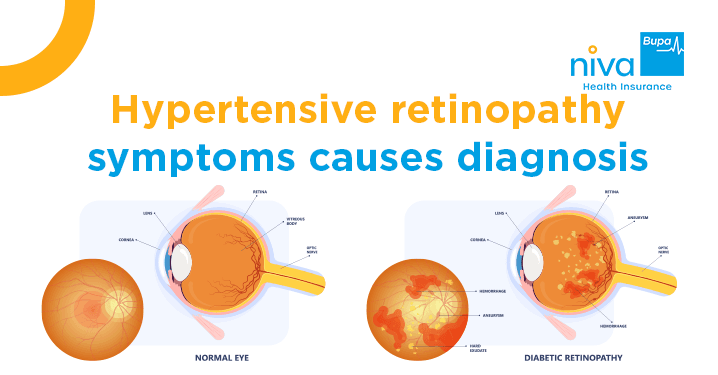 Hypertensive Retinopathy