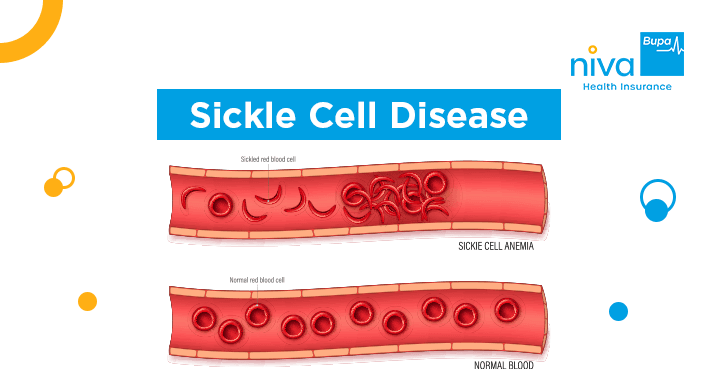 Sickle Cell Disease