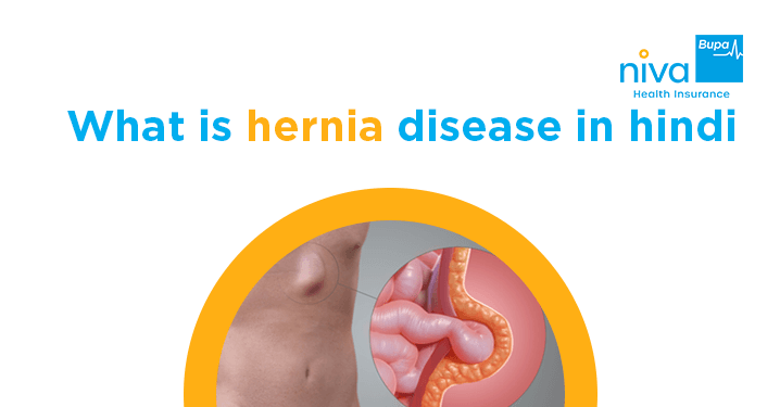 Umbilical Hernia: Symptoms, Causes, Diagnosis, and Treatment Options